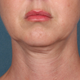 Before image for Anna M.